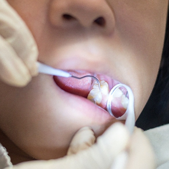 Dentist checking patient’s dental crown in Chesterfield