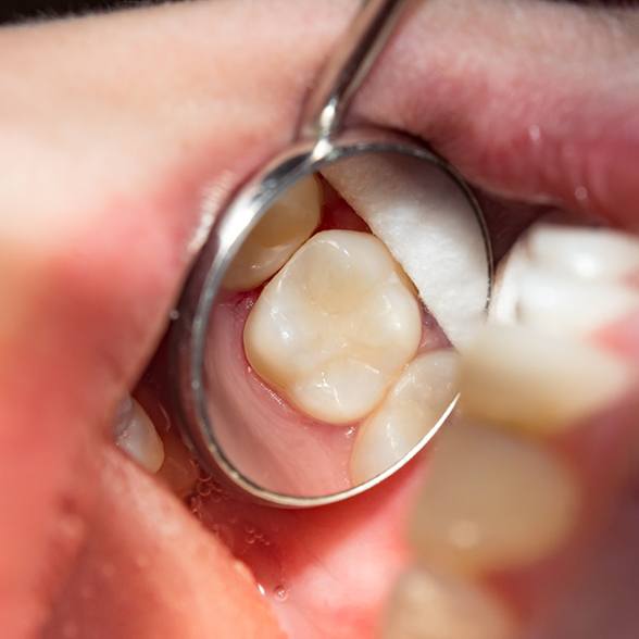Mirror showing tooth-colored filling in patient’s mouth