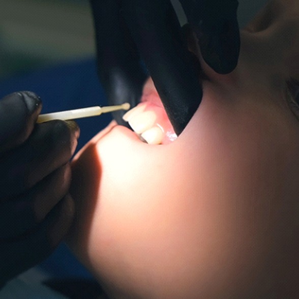 An up-close view of a dentist applying fluoridated gel to a patient’s teeth in Chesterfield