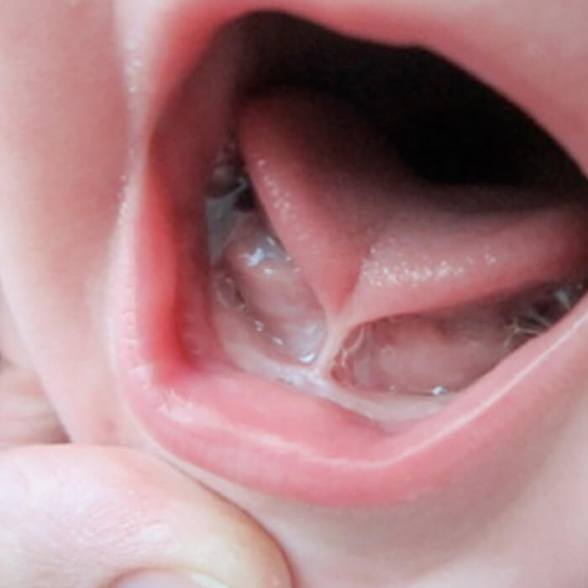 Up-close view of a baby’s tongue tie