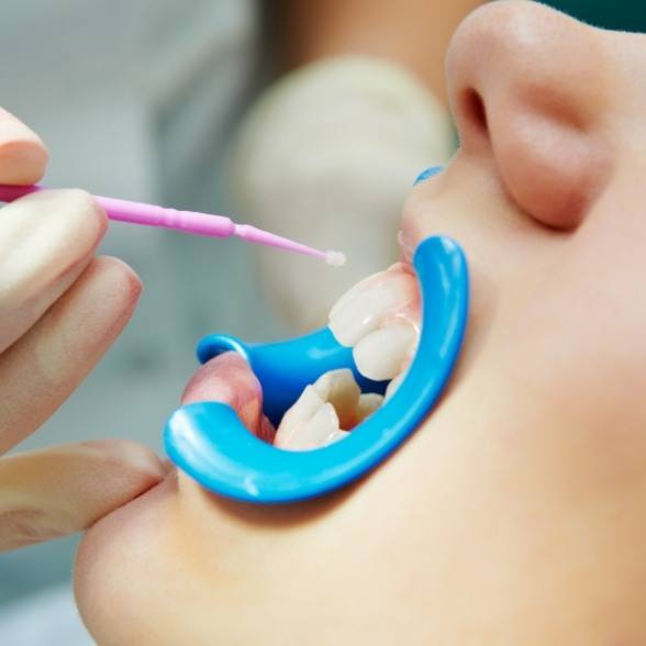 Patient receiving fluoride treatment