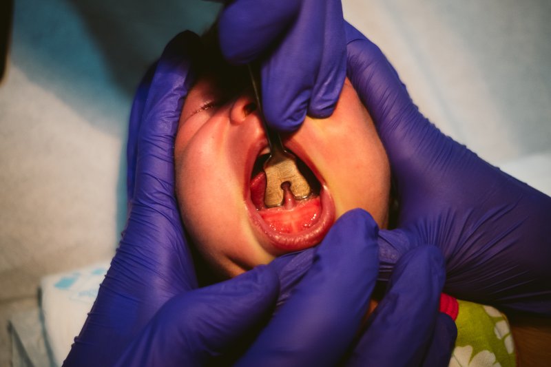 baby with severe tongue tie